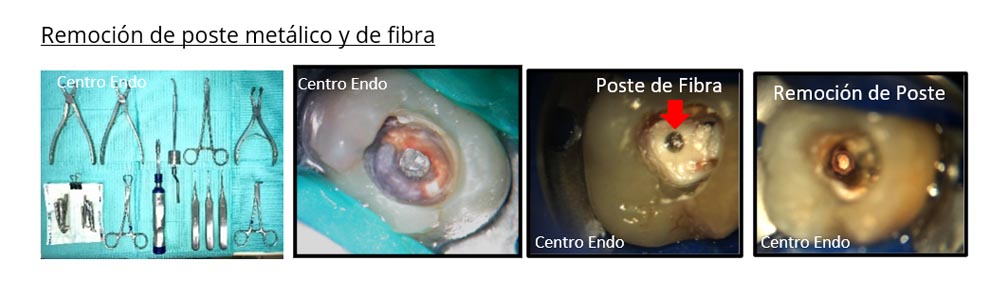 TRATAMIENTOS de Endodoncia ENDO