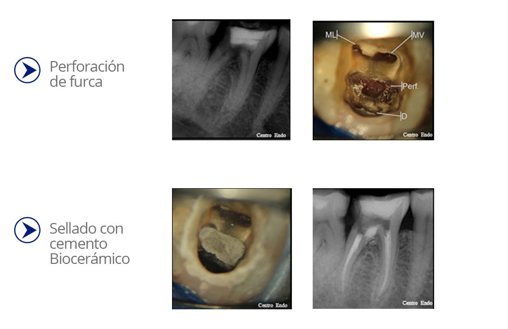 tratamientos de endodoncia